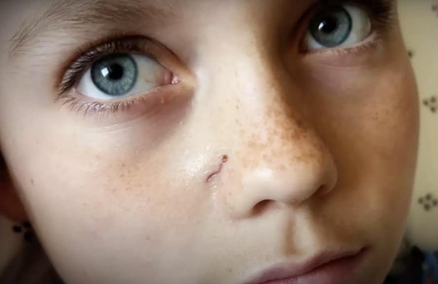 Menino de 9 anos remove flecha após ela atravessar seu cérebro em acidente bizarro A ferida deixada após a flecha atravessar o cérebro de Gus Deterding (KARE 11)