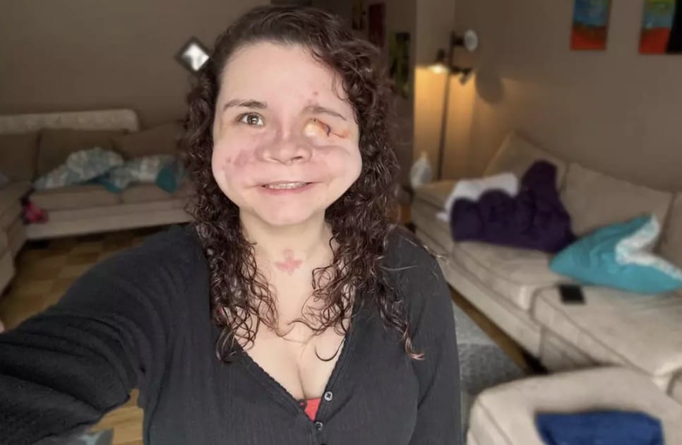 Mulher que recebeu “menos de 2%” de chance de sobrevivência após levar um tiro no rosto compartilha mensagem importante sobre trauma horrível Amedy Dewey foi informada de que tinha chances muito baixas de sobrevivência (Northwell Lenox Hill)
