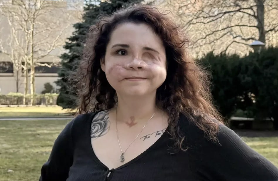 Mulher que recebeu “menos de 2%” de chance de sobrevivência após levar um tiro no rosto compartilha mensagem importante sobre trauma horrível Dewey levou um tiro no rosto de seu padrasto (Amedy Dewey)
