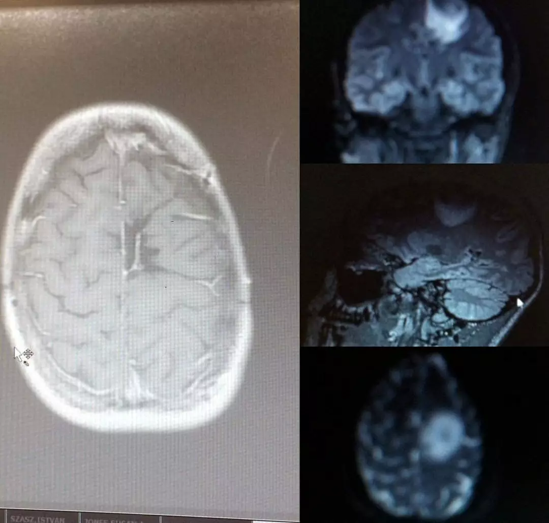 Mulher recebe seis meses de vida depois que médicos confundiram câncer com fobia de aranhas Amy descobriu que tinha um tumor do tamanho de uma bola de golfe crescendo em seu cérebro depois que os médicos inicialmente atribuíram os sintomas à aracnofobia (SWNS)
