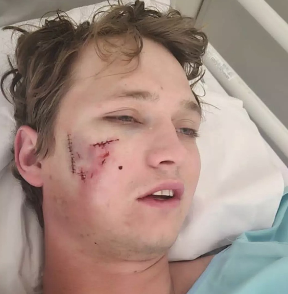 Hohls foi atacado por duas hienas (Nicolas Hohls)