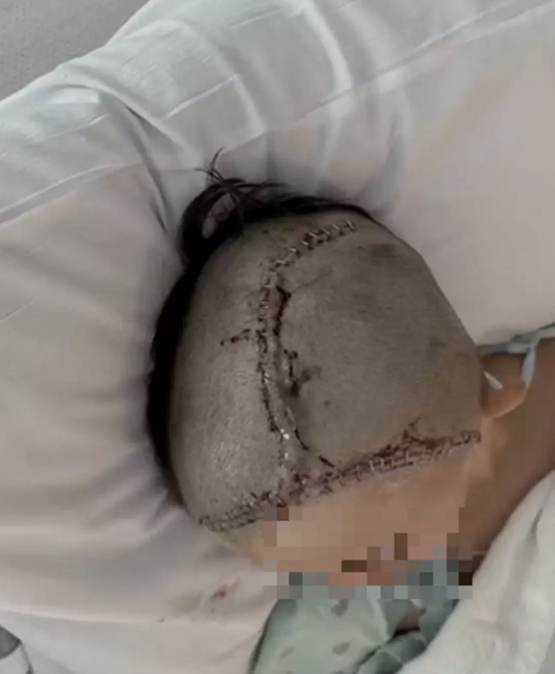 Adolescente atacado por colega após fazer uma piada tem a cabeça reconstruída enquanto a família divulga uma atualização chocante O adolescente de 14 anos teria sido atacado na cafeteria de sua escola (KBTX)