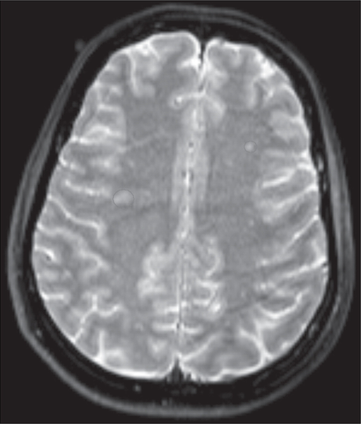 Ressonância magnética cerebral que mostra lesões de substância branca no centro semioval