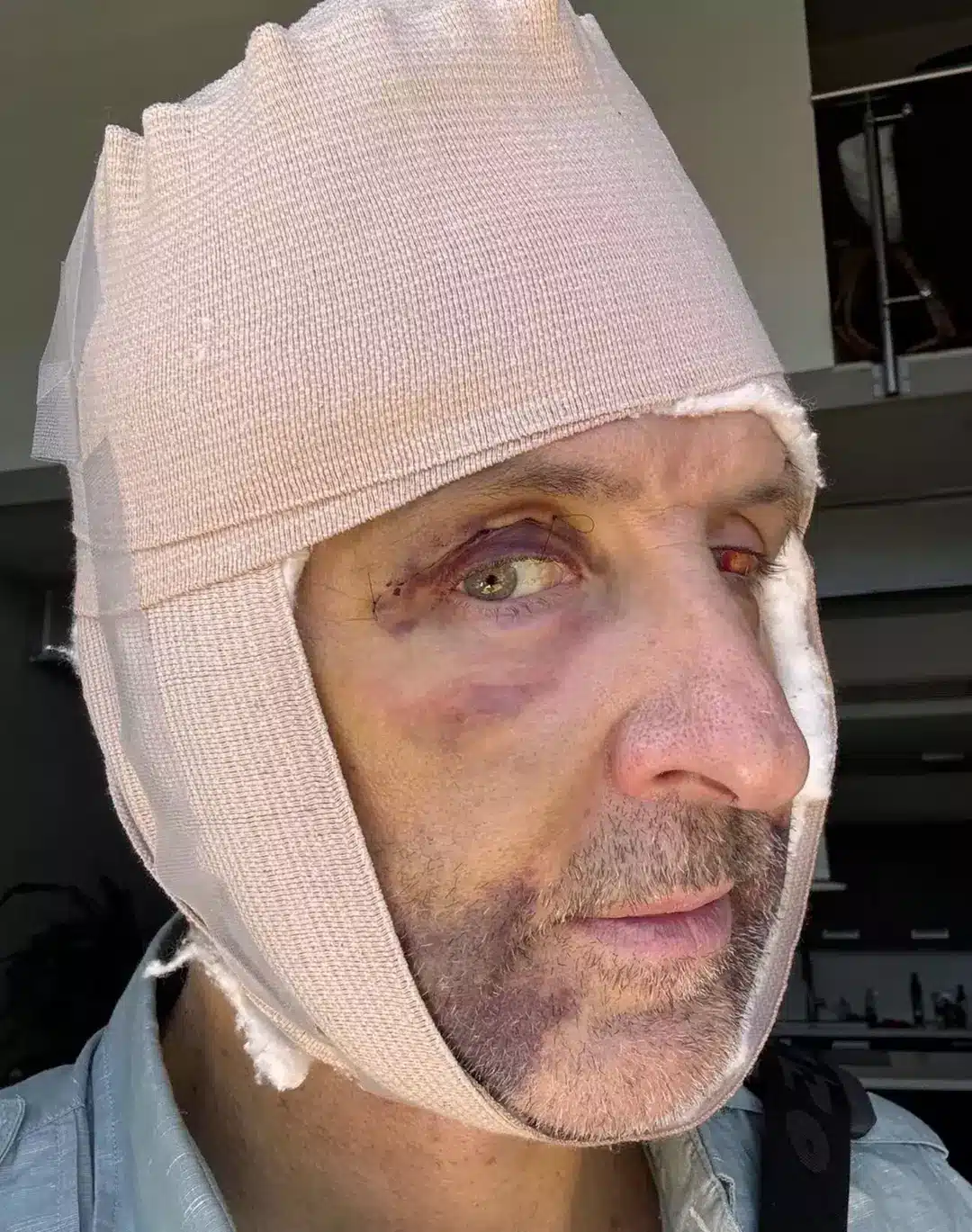 Homem injeta células das nádegas no rosto em busca de "viver para sempre" O empresário passou pelo procedimento radical na Costa Rica (Dave Asprey/Facebook)