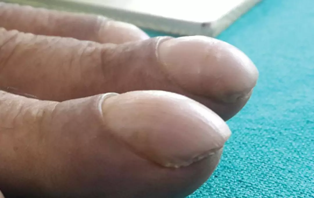 O hipocratismo digital pode alterar a estrutura e a aparência das unhas (Cleveland Clinic Journal of Medicine)