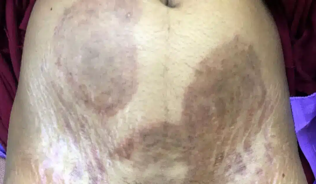 Especialistas alertam que o “superfungo” está se espalhando (MDPI)