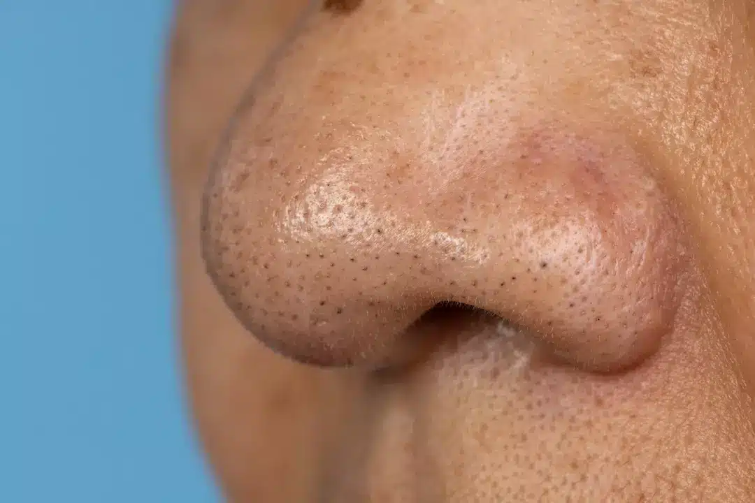 Cravos são simplesmente um tipo de acne