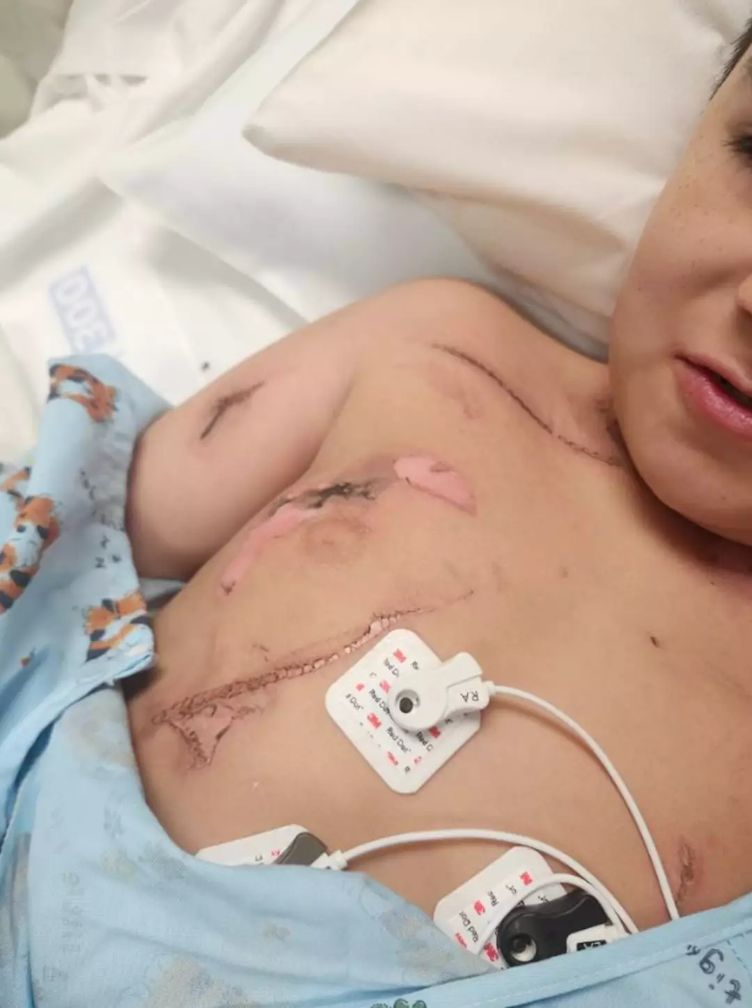 Lorenzo ficou com queimaduras no pescoço e no corpo