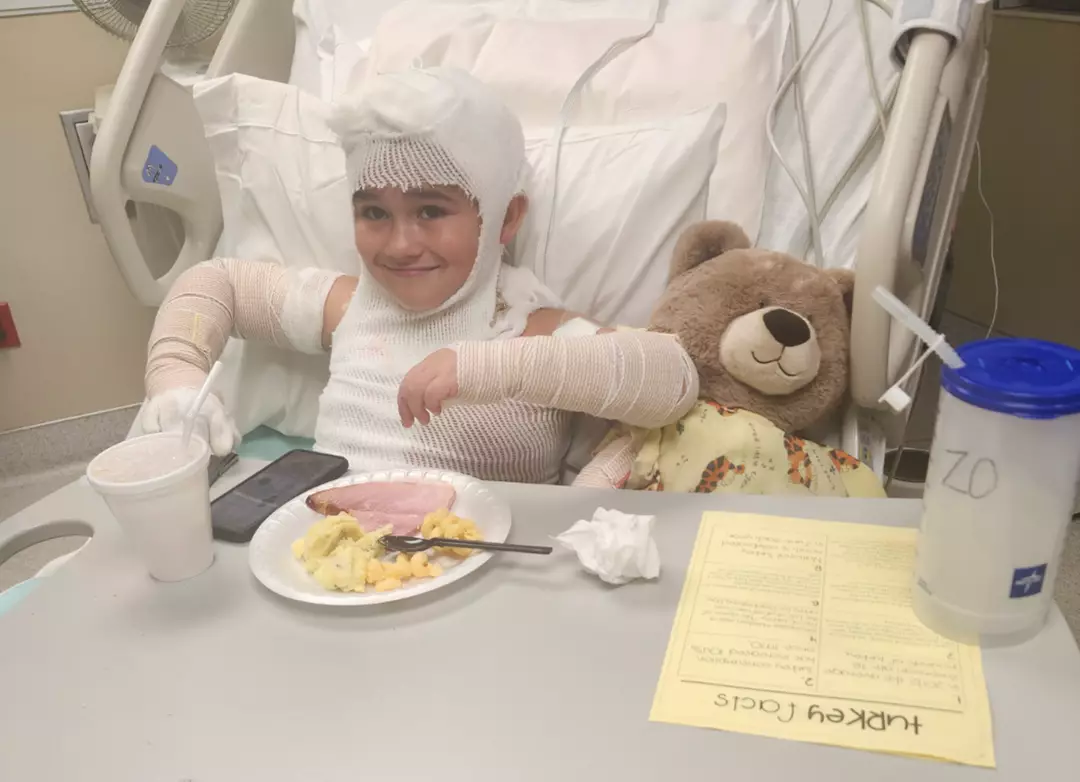 Lorenzo passou por uma cirurgia de enxerto de pele depois de ser eletrocutado