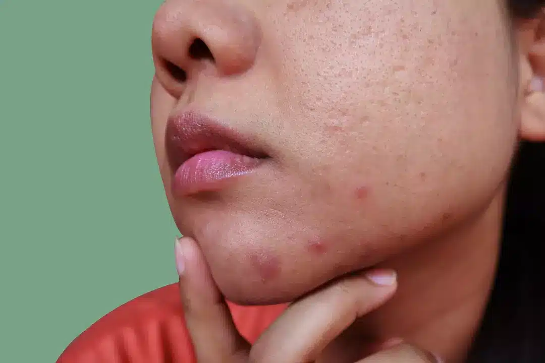 Mas, segundo o Dr. Ellis, você realmente não deve “mexer” em acne cística