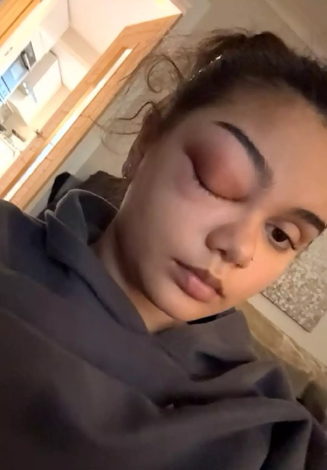 O olho de Sophie “saltou” como uma bola de golfe (Kennedy News and Media)