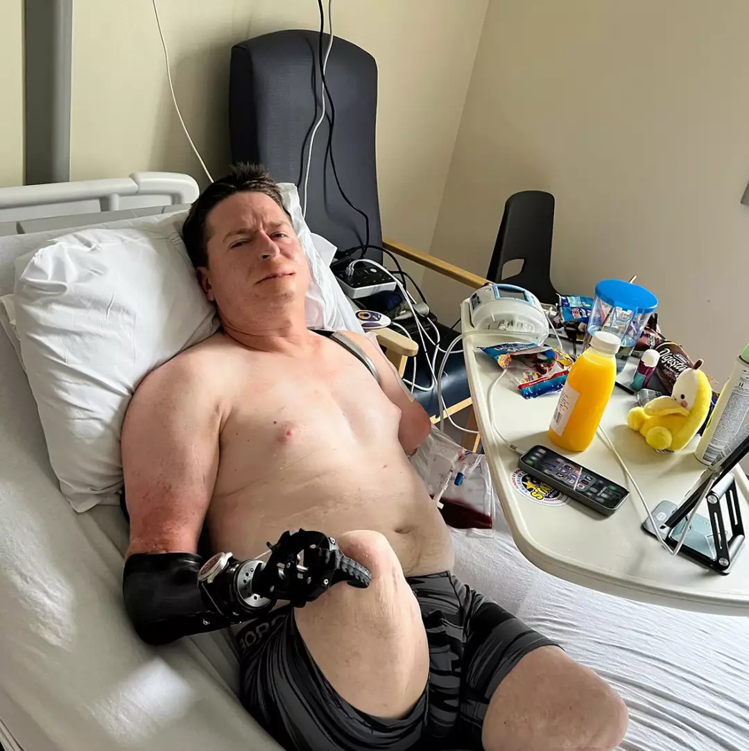 Ele continua precisando de 'revisões cirúrgicas regulares' (Instagram/@alexlewisalff)