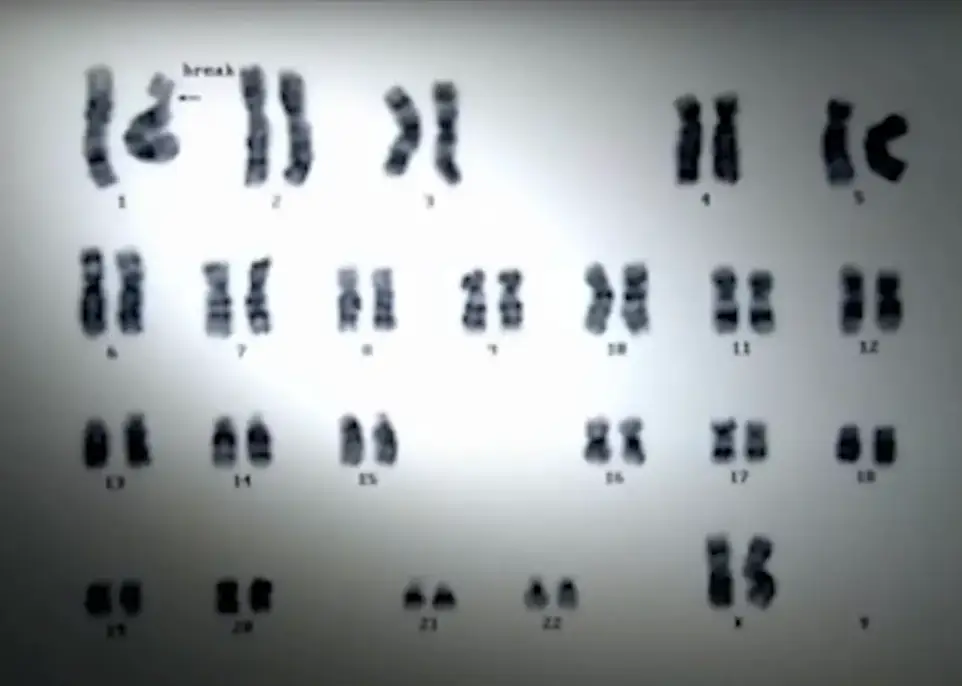 Alterações no DNA de Ouchi, causadas pela dose fatal de radiação (NHK)
